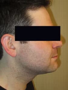 After Image: Patient LL4451