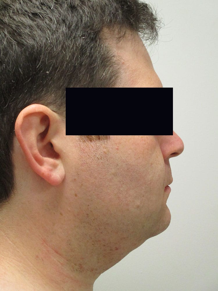 Before Image: Patient LL4451 - right-side