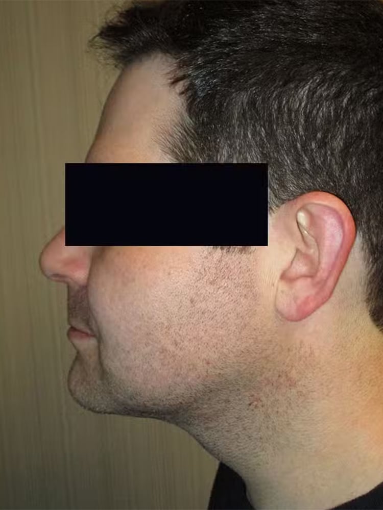 After Image: Patient LL4451 - left-side