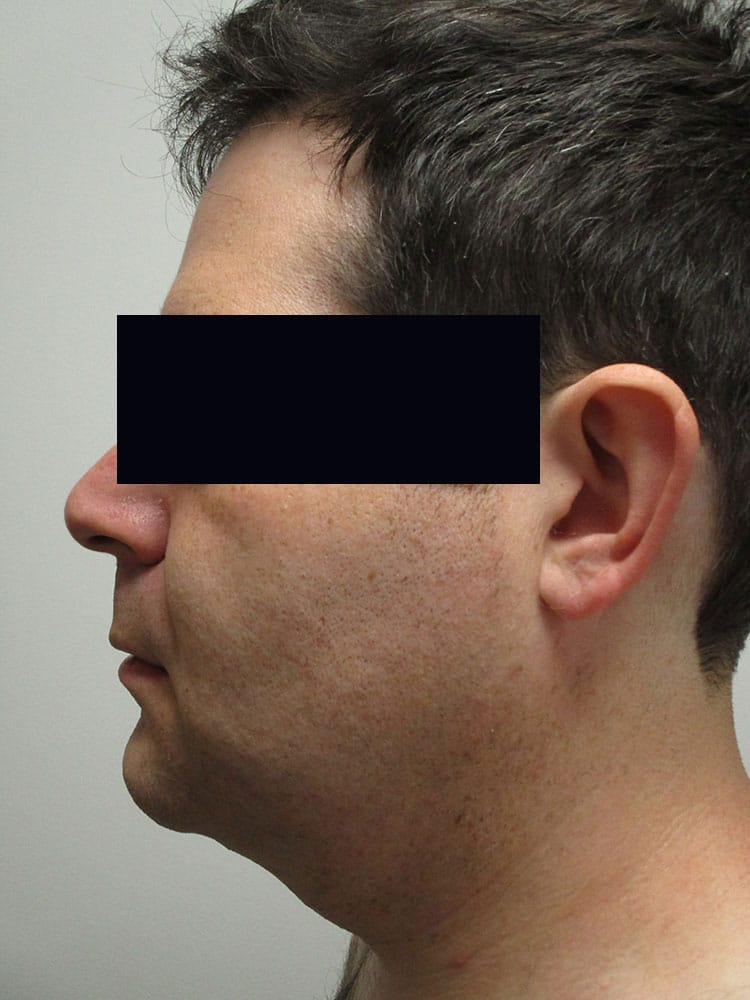 Before Image: Patient LL4451 - left-side