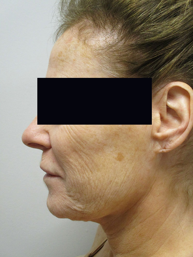 Before Image: Patient LL22028 - left-side