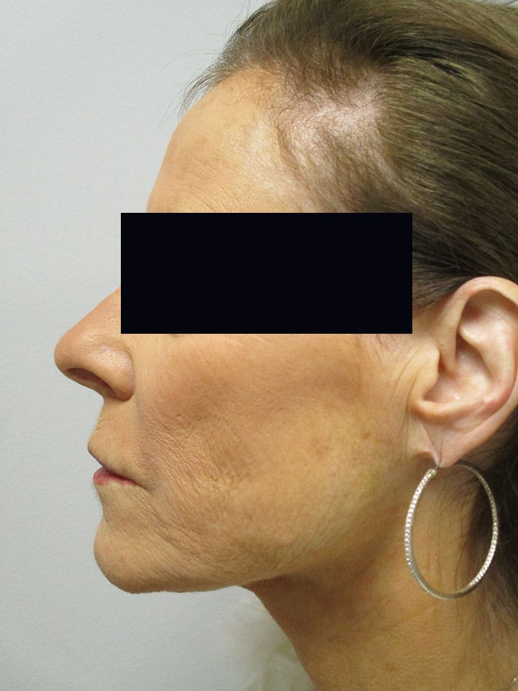 After Image: Patient LL22028 - left-side