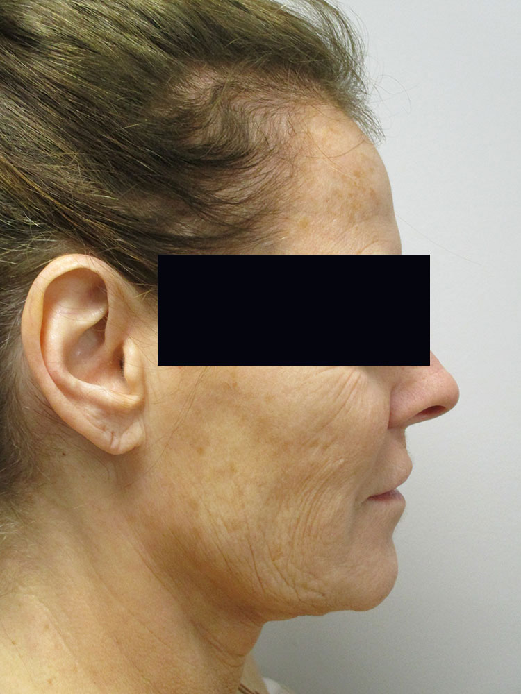 Before Image: Patient LL22028 - right-side