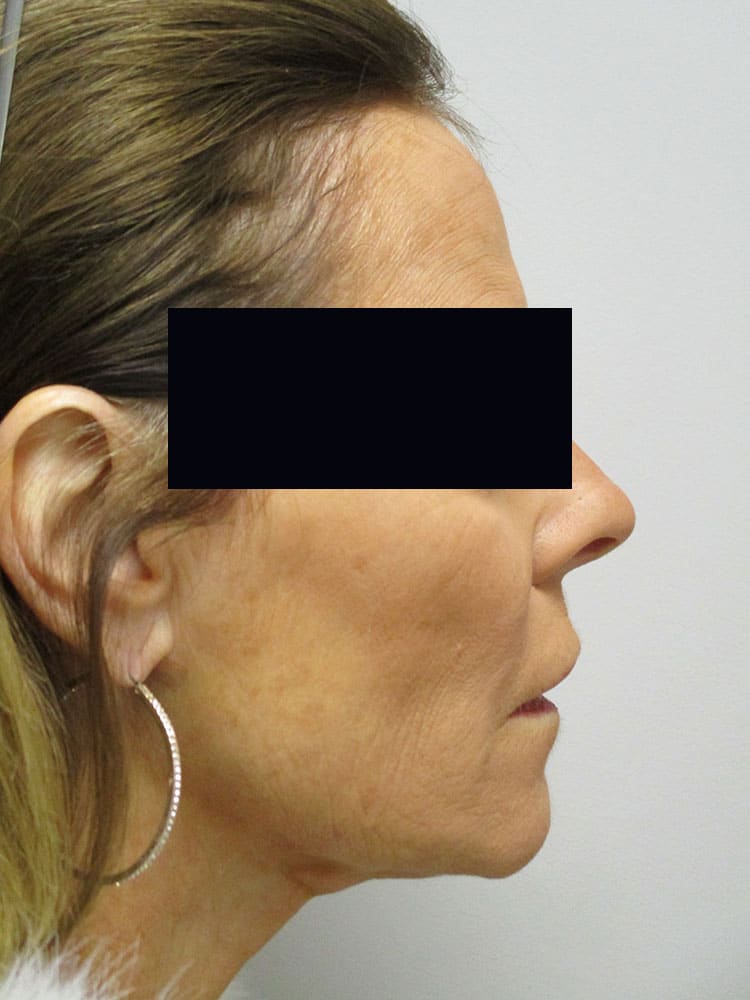 After Image: Patient LL22028 - right-side