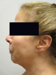 Before Image: Patient LL21257