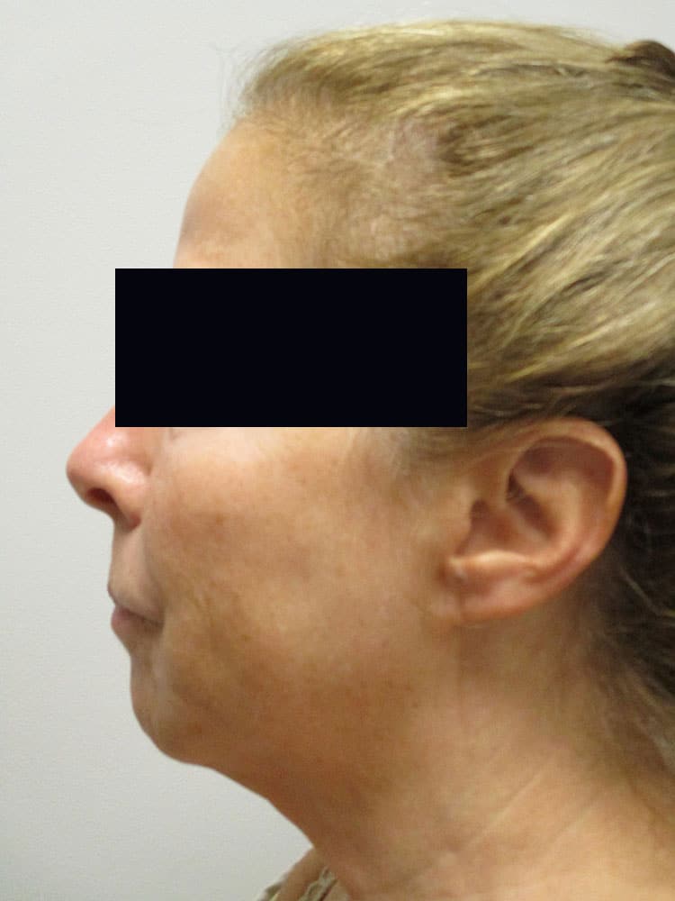 Before Image: Patient LL21257 - left-side