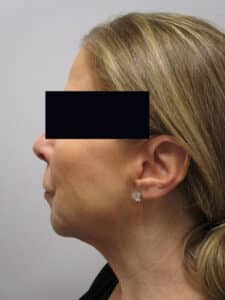 After Image: Patient LL21257