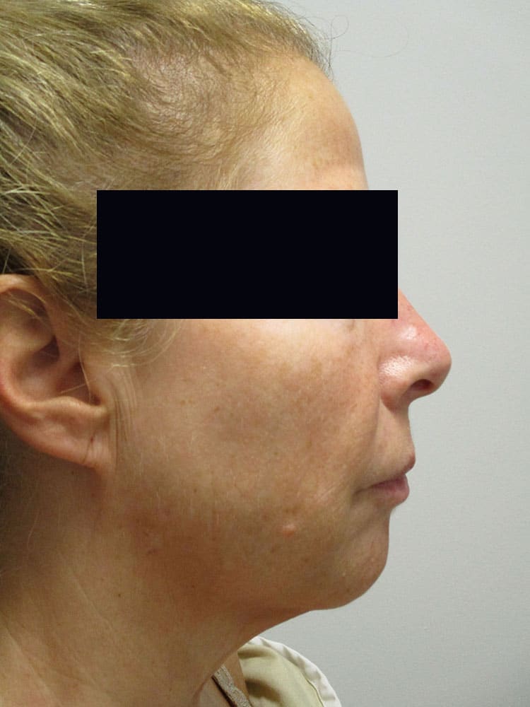 Before Image: Patient LL21257 - right-side