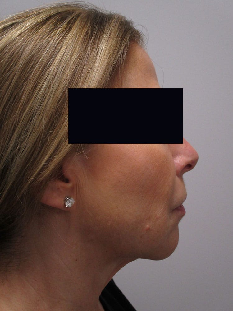 After Image: Patient LL21257 - right-side