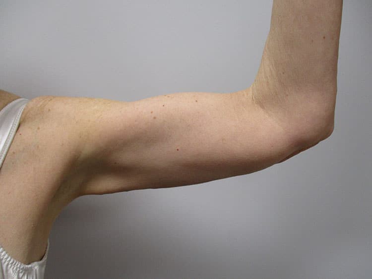 After Image: Patient ARM22170 - front