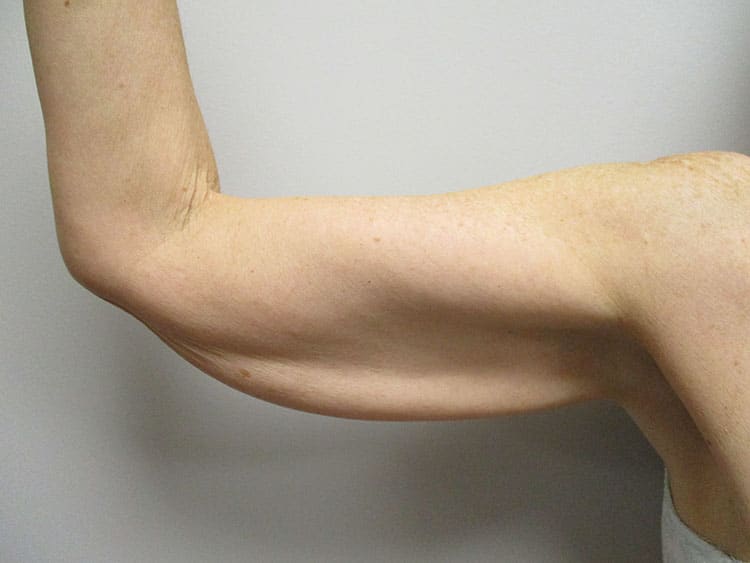 Before Image: Patient ARM22170 - front