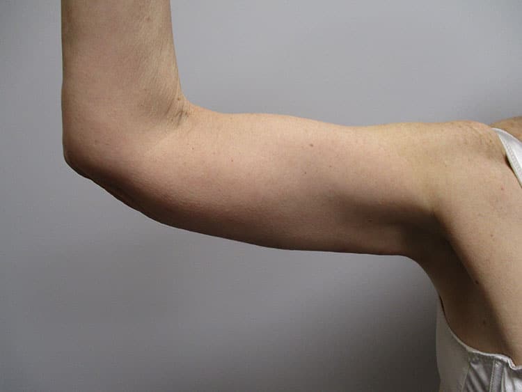 After Image: Patient ARM22170 - front