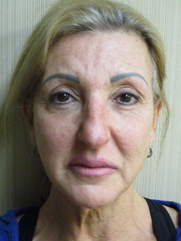 Before Image: Patient F12216 - front