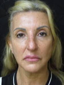 After Image: Patient F12216