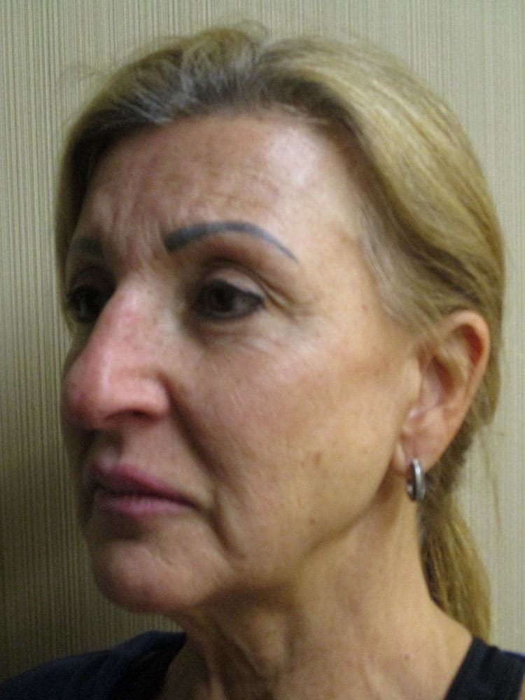 Before Image: Patient F12216 - left-front-oblique