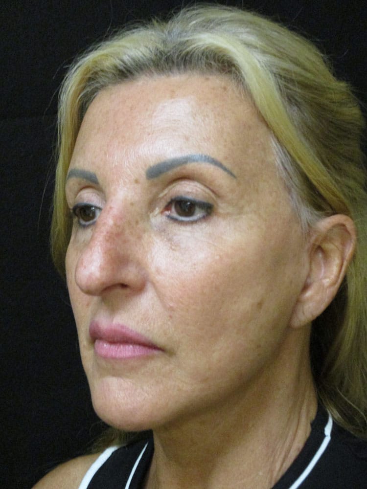 After Image: Patient F12216 - left-front-oblique