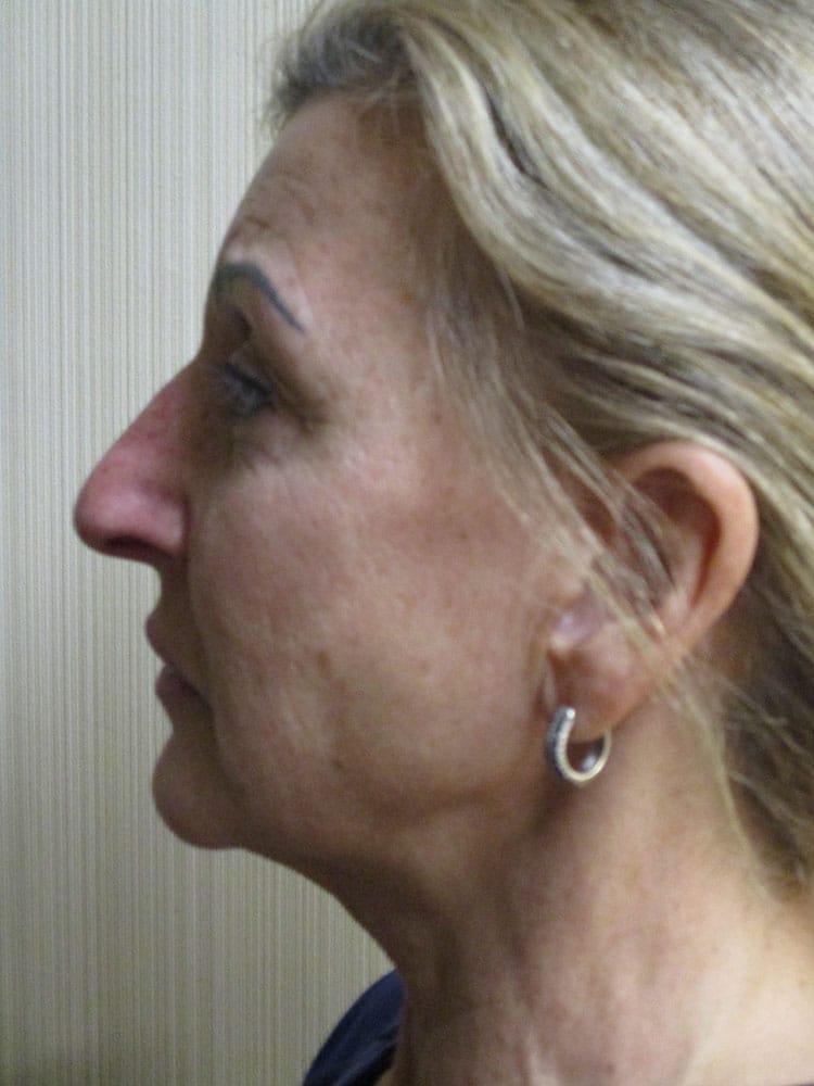 Before Image: Patient F12216 - left-side