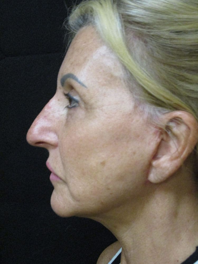 After Image: Patient F12216 - left-side