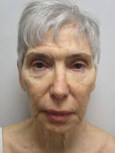 Before Image: Patient F22170