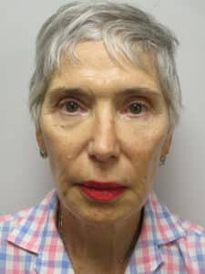 After Image: Patient F22170