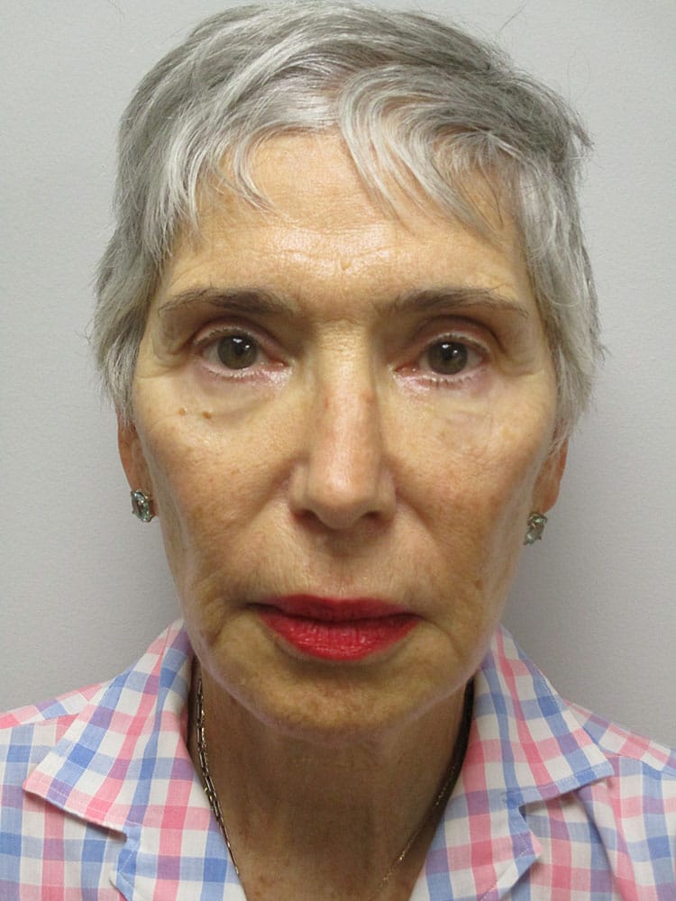 After Image: Patient F22170 - front