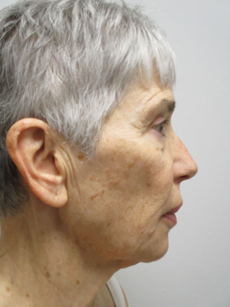 Before Image: Patient F22170 - right-side