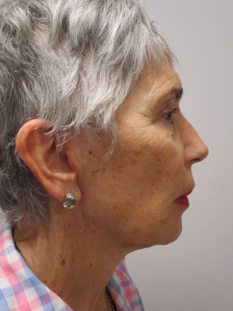 After Image: Patient F22170 - right-side