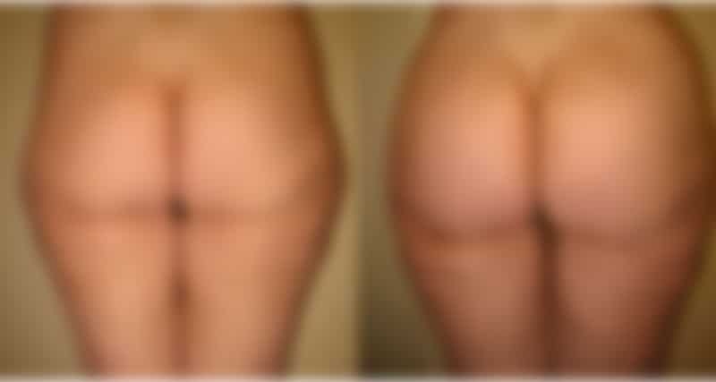 Butt Augmentation (Brazilian Butt Lift) on Long Island, NY
