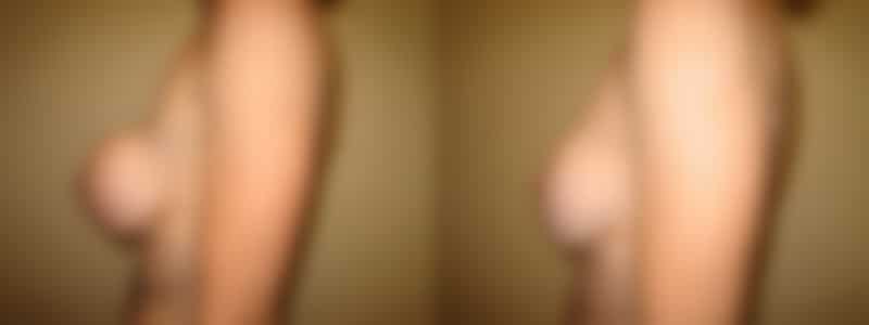 Breast Reconstruction in Long Island, NY