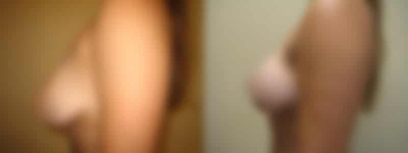 Breast Lift in Long Island, NY