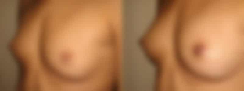 Inverted Nipple Correction in Long Island, NY