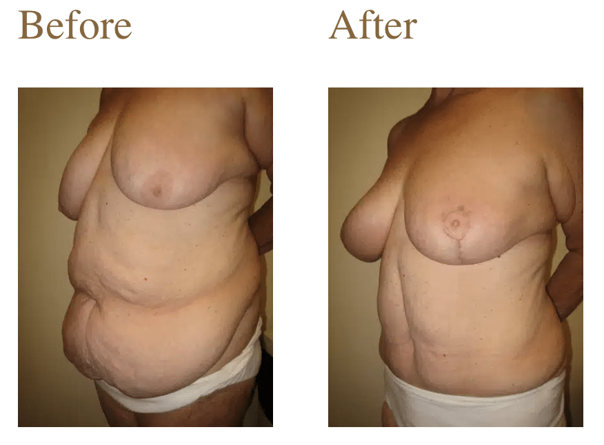 Screenshot 2026-05-15 at 10.16.38 AM Candidates for Post-Weight Loss Surgery Article