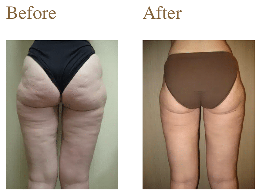 Screenshot 2026-05-15 at 11.32.21 AM Liposuction Article in the News
