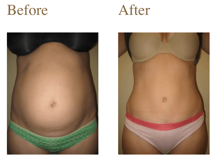 Screenshot 2026-05-15 at 11.52.06 AM Tummy Tuck Article in the News