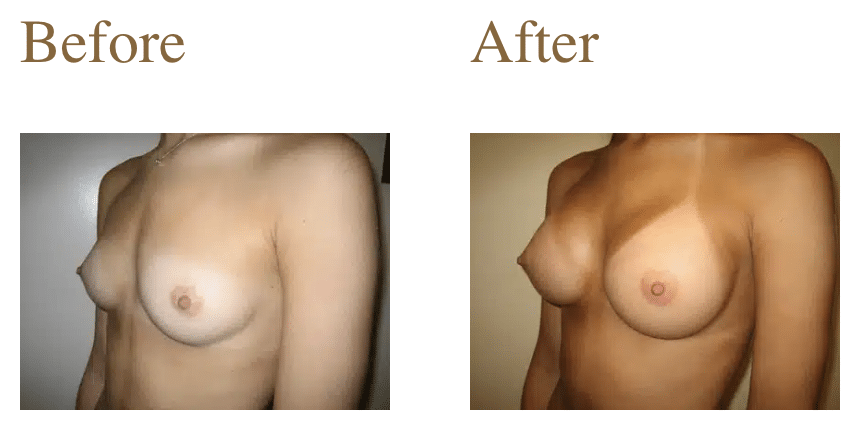 Screenshot 2026-05-15 at 9.48.32 AM Breast Augmentation News Article