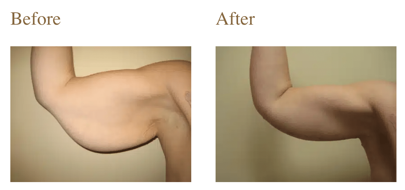 Arm Lift Surgery Long Island, NY