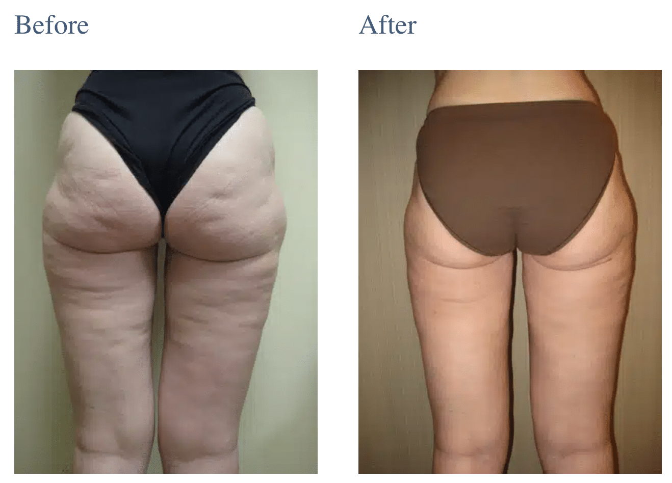 Cellulaze Cellulite Treatment in Long Island, NY