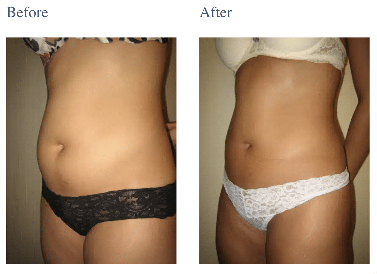 Liposuction in Long Island, NY