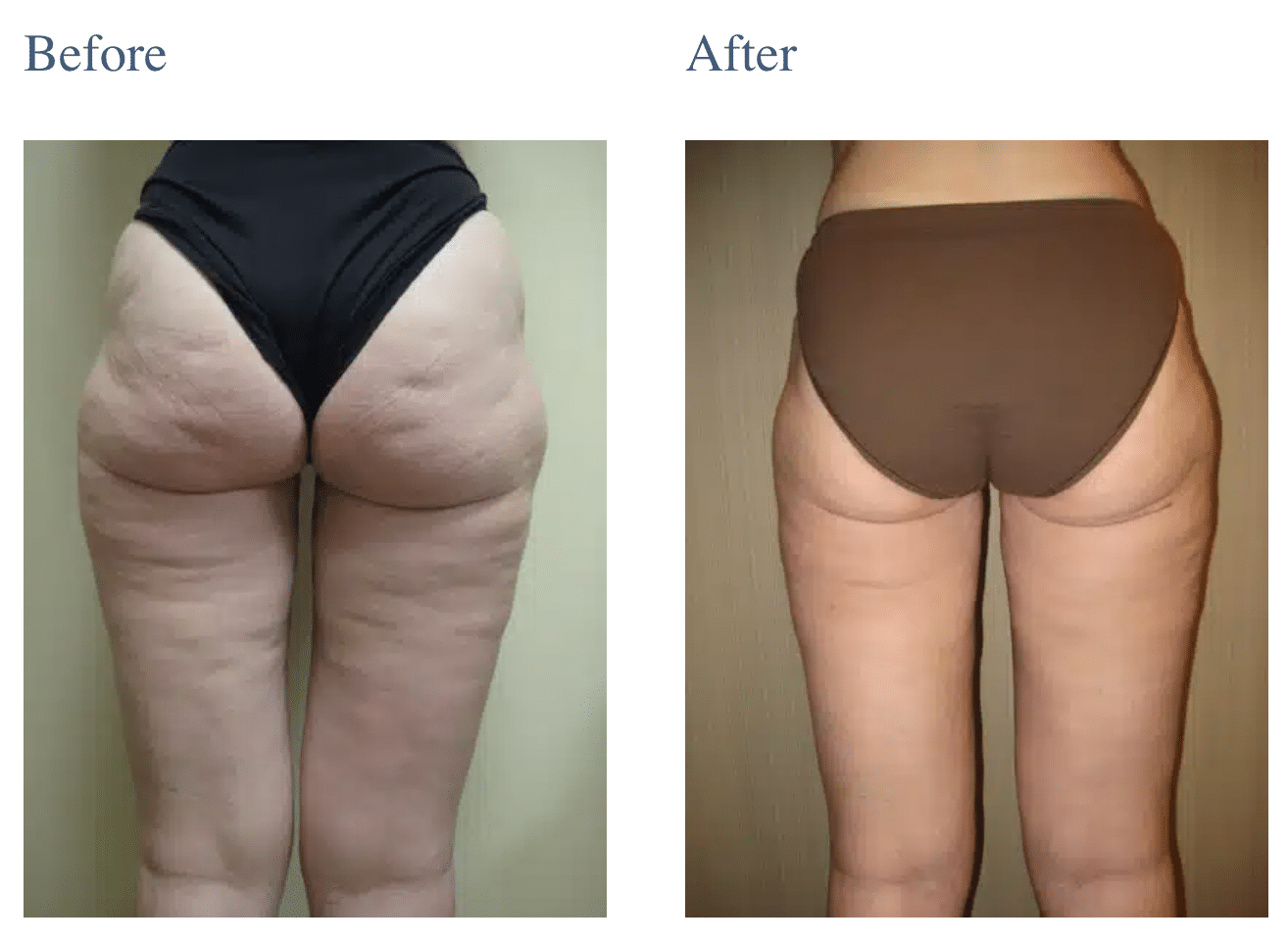 SmartLipo Liposuction in Long Island, NY