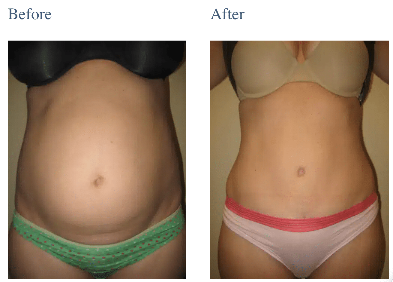 Tummy Tuck in Long Island, NY