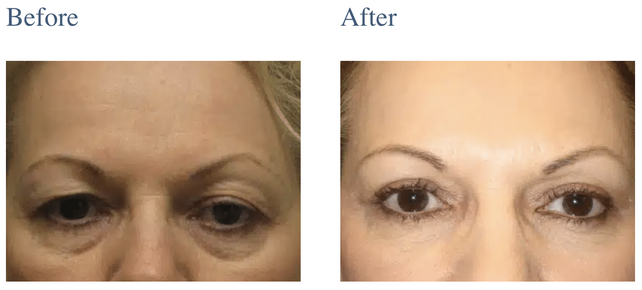 Eyelid Surgery in Long Island, NY