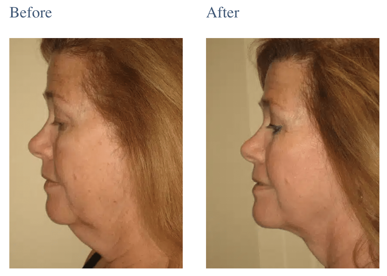 LaserLift Facial Rejuvenation in Long Island, NY