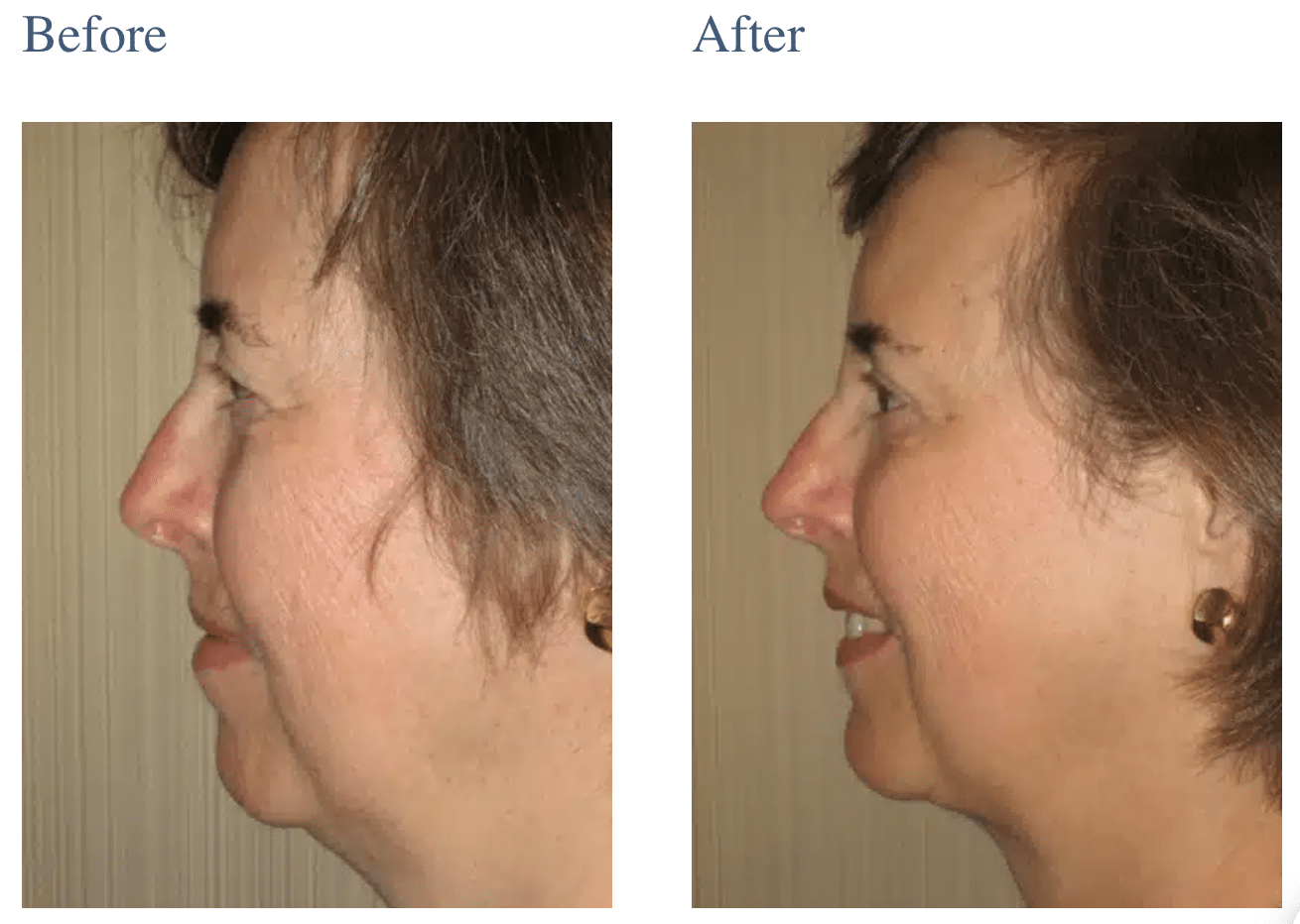 Neck Lift Surgery in Long Island, NY