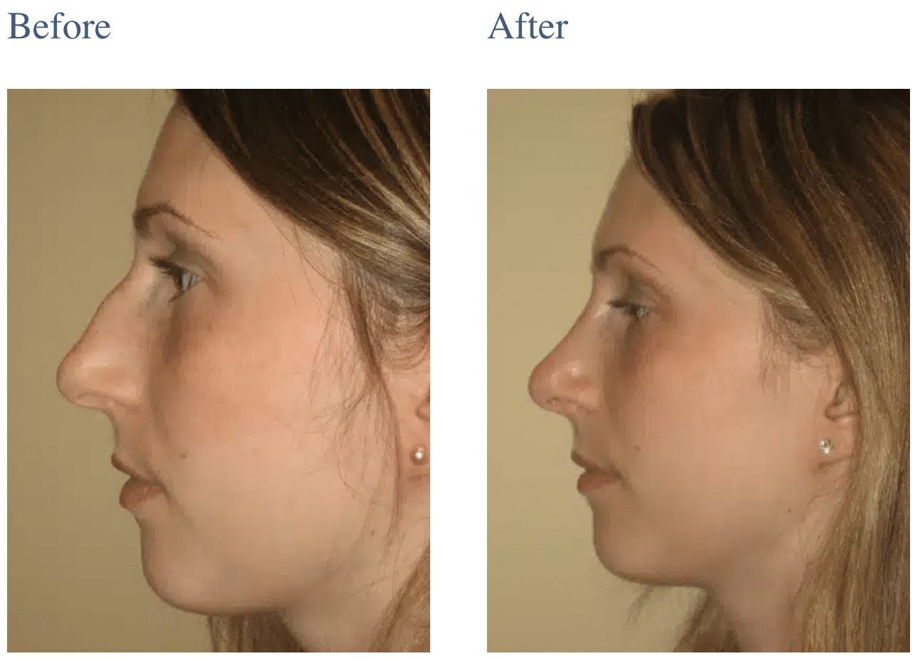 Rhinoplasty in Long Island, NY