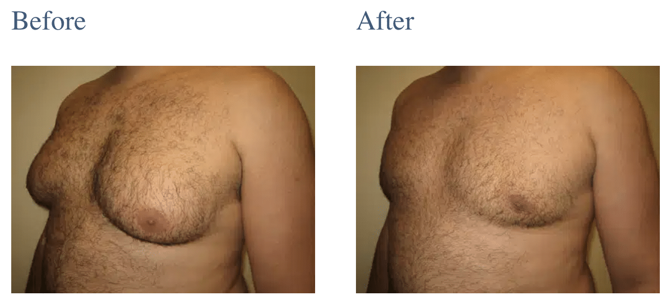 Male Breast Reduction in Long Island, NY
