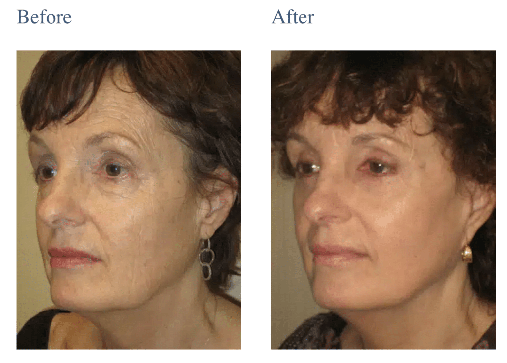 Chin Implants in Long Island, NY