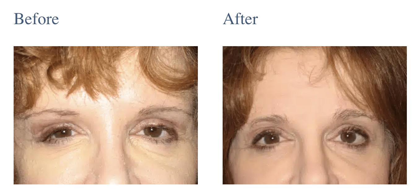 Brow Lift (Forehead Lift) in Long Island, NY