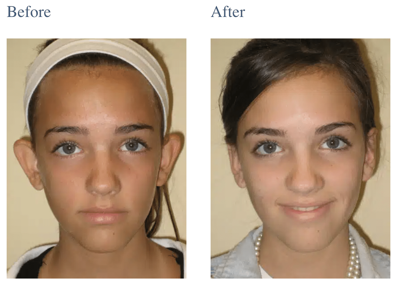 Ear Surgery (Otoplasty) in Long Island, NY