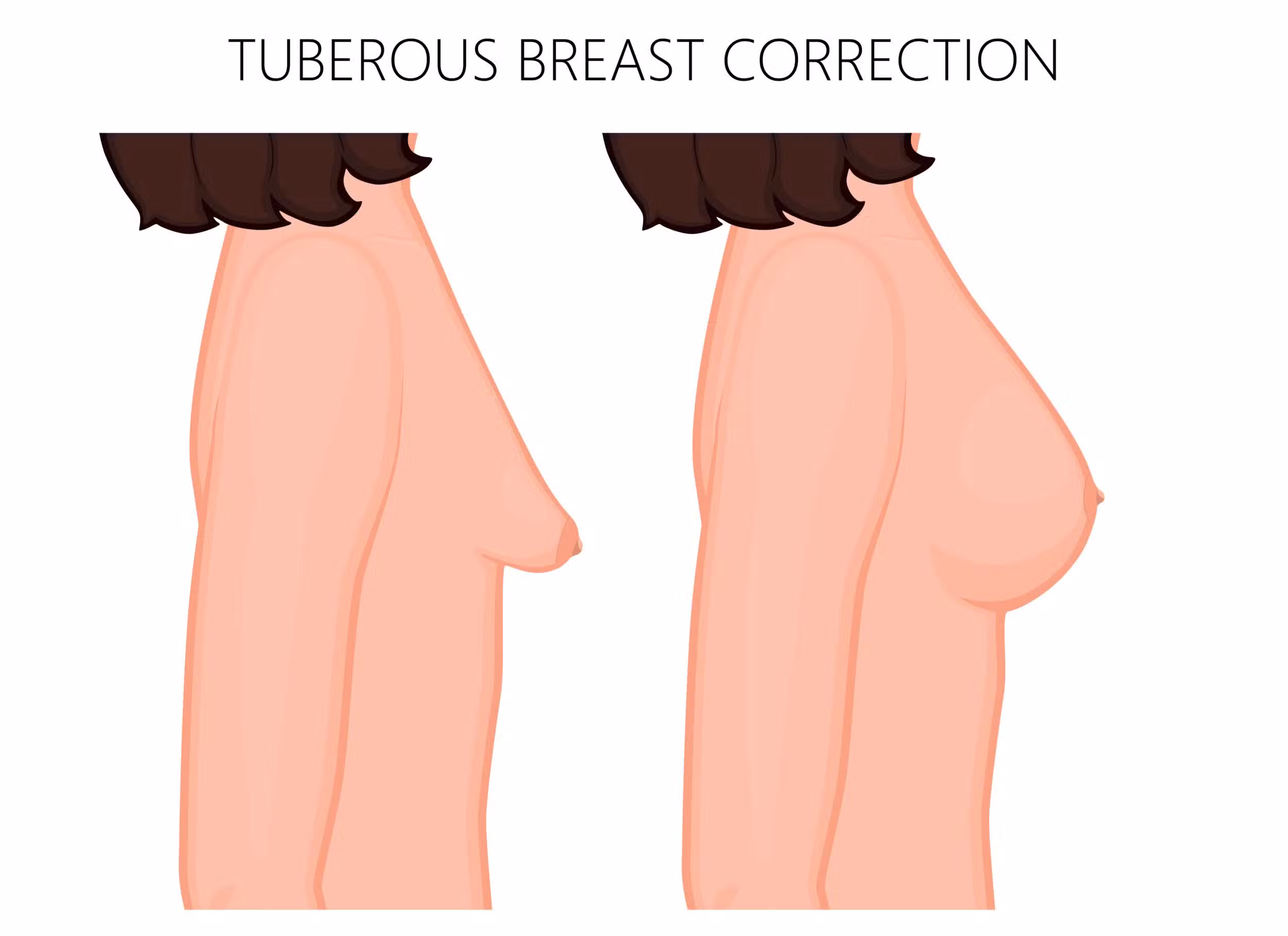 Tubular Breast Correction in Long Island