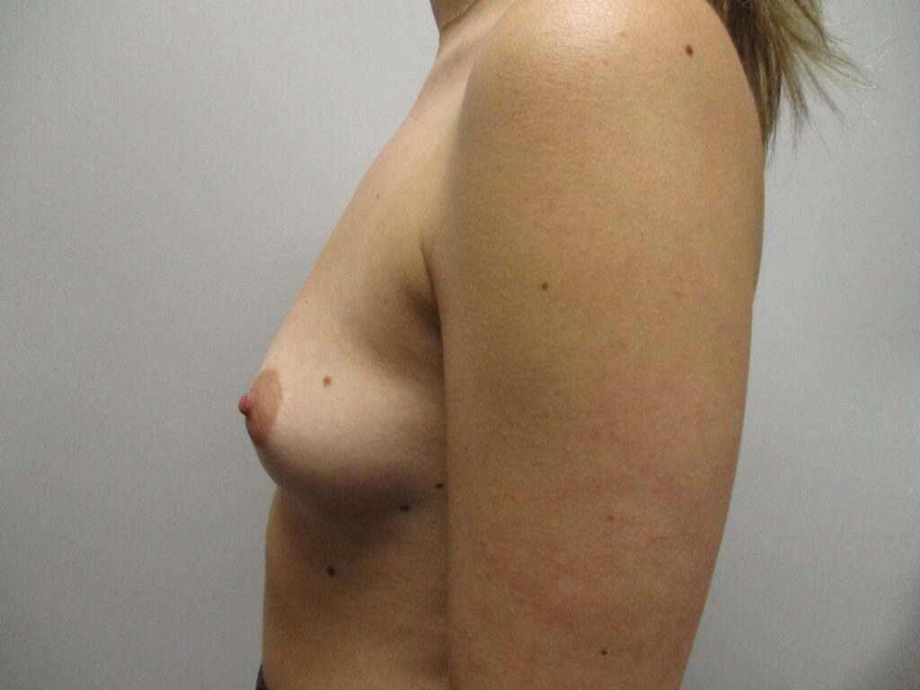 Before Image: Patient BA23148 - left-side